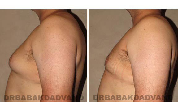 Before and After Photos -Gynecomastia - 35 year old male, -left side view