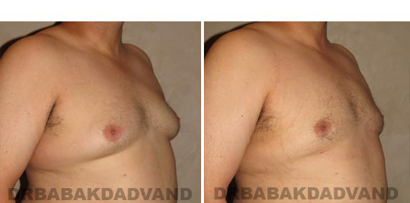 Before and After Photos -Gynecomastia - 35 year old male, -right side, oblique view