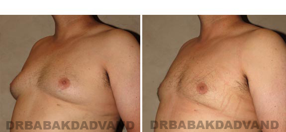 Before and After Photos -Gynecomastia - 35 year old male, -left side, oblique view