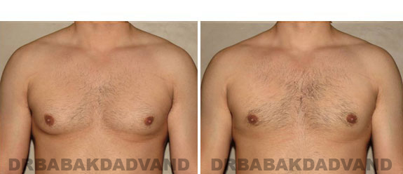 Breast-Gynecomastia: Before and After Photos. 32 year old man, front view