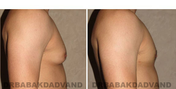 Breast-Gynecomastia: Before and After Photos. 32 year old man, right side view