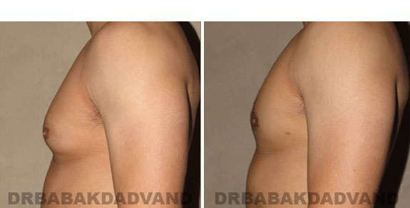Breast-Gynecomastia: Before and After Photos. 32 year old man, left side view