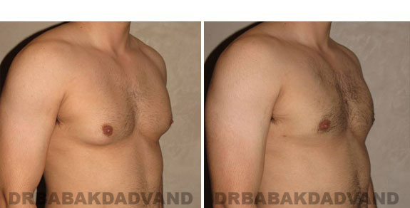 Breast-Gynecomastia: Before and After Photos. 32 year old man, right side, oblique view