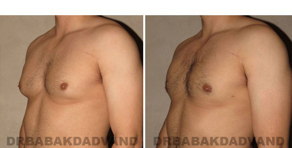 Breast-Gynecomastia: Before and After Photos. 32 year old man, left side, oblique view