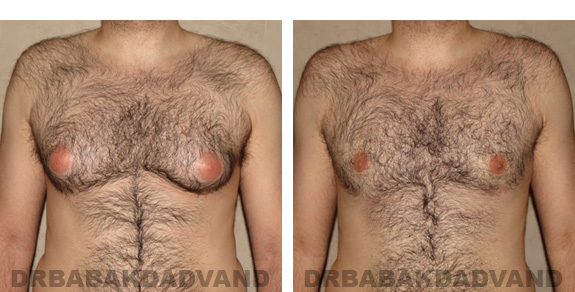 Before and After Photos |Gynecomastia| 28 year old male, - front view