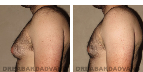 Before and After Photos |Gynecomastia| 28 year old male, - left side view