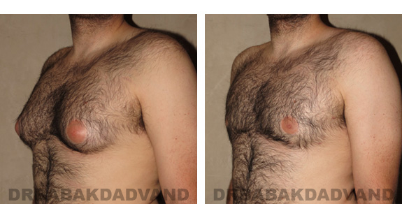 Before and After Photos |Gynecomastia| 28 year old male, - left side, oblique view