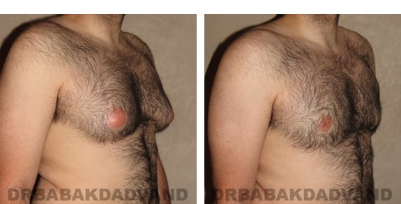 Before and After Photos |Gynecomastia| 28 year old male, - right side, oblique view