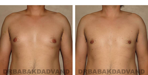Before and After Photos |Gynecomastia| 27 year old man, - front view
=
