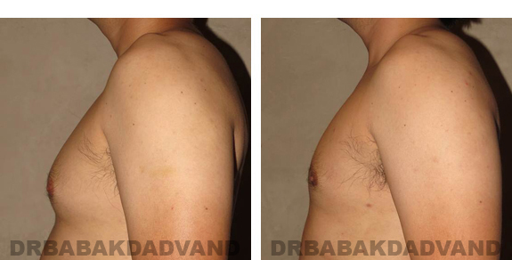 Before and After Photos |Gynecomastia| 27 year old man, - left side view