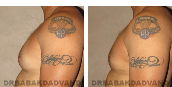 Before and After Photos |Gynecomastia| 34 year old man, - left side view