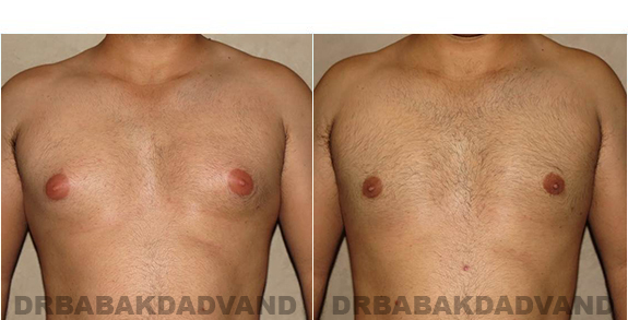 Before and After Photos. Breast-Gynecomastia: - 27 year old male, front view