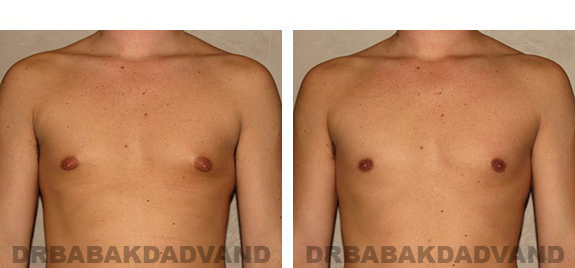 Before and After Photos. Breast-Gynecomastia: - 31 year old male, front view