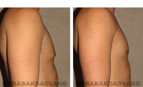 Before and After Photos. Breast-Gynecomastia: - 31 year old male, right side view