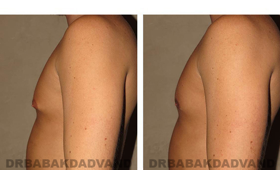 Before and After Photos. Breast-Gynecomastia: - 31 year old male, left side view