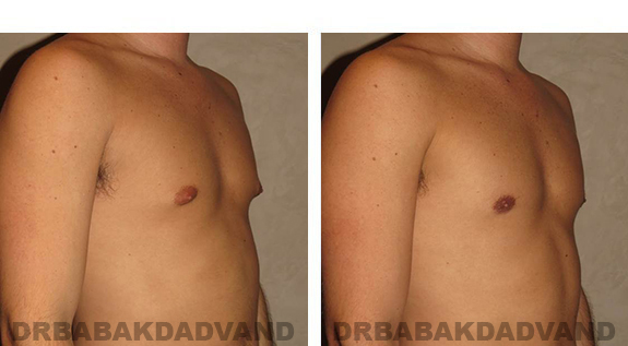 Before and After Photos. Breast-Gynecomastia: - 31 year old male, right side, oblique view