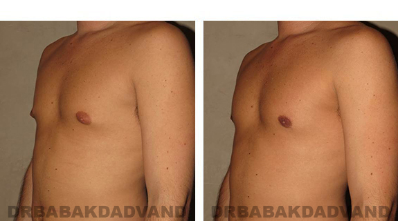 Before and After Photos. Breast-Gynecomastia: - 31 year old male, left side, oblique view