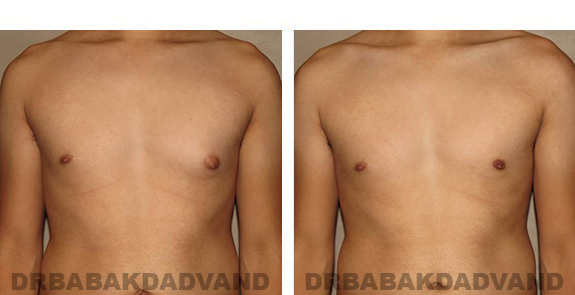 Before and After Photos. Breast-Gynecomastia: - 24 year old male, front view