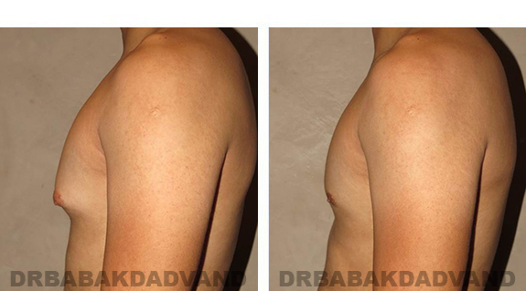 Before and After Photos. Breast-Gynecomastia: - 24 year old male, left side view