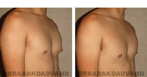 Before and After Photos. Breast-Gynecomastia: - 24 year old male, right side, oblique view