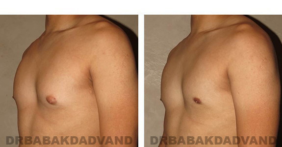 Before and After Photos. Breast-Gynecomastia: - 24 year old male, left side, oblique view