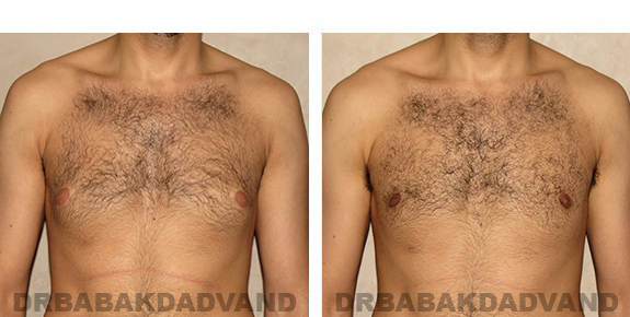 Before and After Photos. Breast-Gynecomastia: - 24 year old man, front view