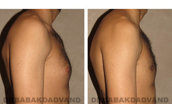 Before and After Photos. Breast-Gynecomastia: - 24 year old man, right side view