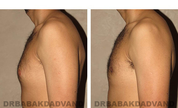 Before and After Photos. Breast-Gynecomastia: - 24 year old man, left side view
