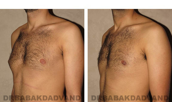 Before and After Photos. Breast-Gynecomastia: - 24 year old man, left side, oblique view