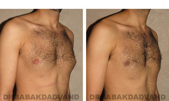 Before and After Photos. Breast-Gynecomastia: - 24 year old man, right side, oblique view