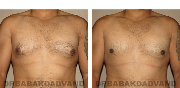 Before and After Photos |Gynecomastia| 28 year old man, - front view