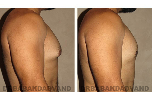 Before and After Photos |Gynecomastia| 28 year old man, - right side view