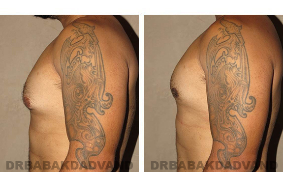 Before and After Photos |Gynecomastia| 28 year old man, - left side view