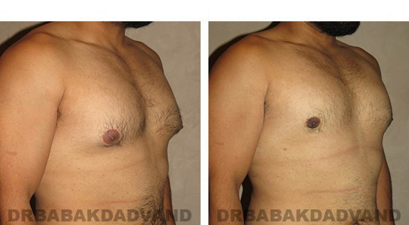 Before and After Photos |Gynecomastia| 28 year old man, - right side, oblique view