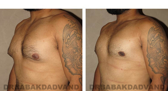 Before and After Photos |Gynecomastia| 28 year old man, - left side, oblique view