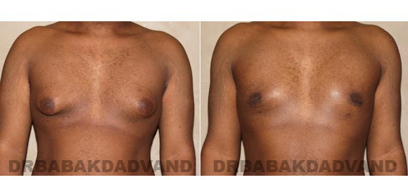Before and After Photos. Breast-Gynecomastia: - 22 year old male, front view