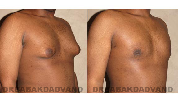 Before and After Photos. Breast-Gynecomastia: - 22 year old male, right side, oblique view