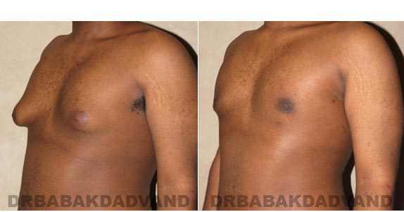 Before and After Photos. Breast-Gynecomastia: - 22 year old male, left side, oblique view