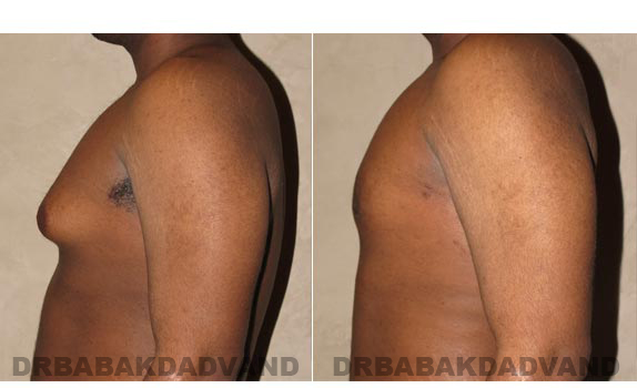 Before and After Photos. Breast-Gynecomastia: - 22 year old male, left side view