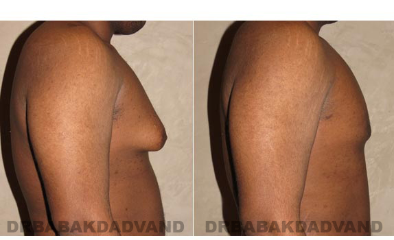 Before and After Photos. Breast-Gynecomastia: - 22 year old male, right side view