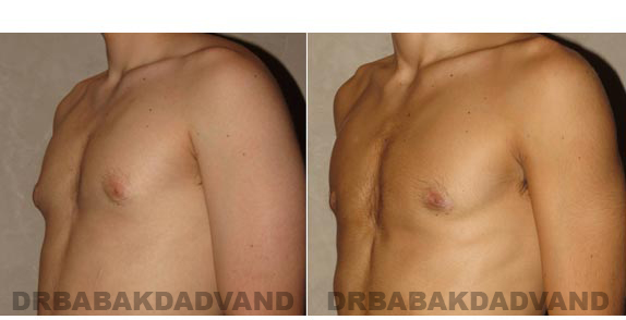 Breast-Gynecomastia: Before and After Photos. 17 year old man, -left side, oblique view