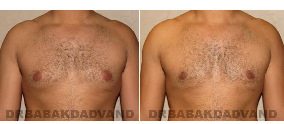 Before and After Photos -Gynecomastia - 28 year old man, - front view