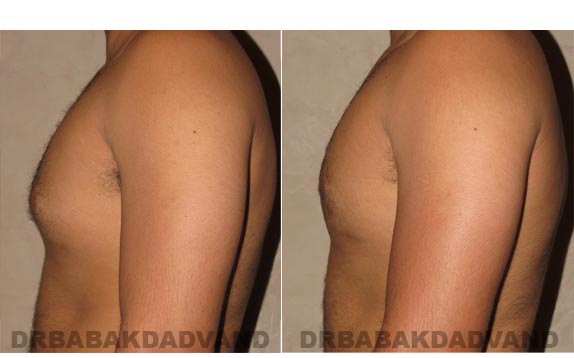 Before and After Photos -Gynecomastia - 28 year old man, -left side view