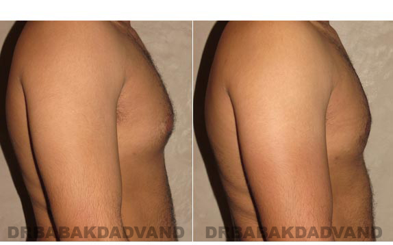 Before and After Photos -Gynecomastia - 28 year old man, -right side view