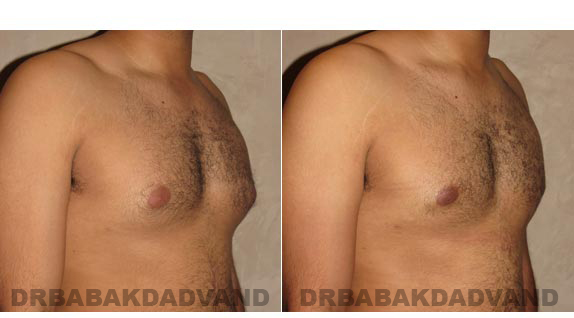 Before and After Photos -Gynecomastia - 28 year old man, -right side, oblique view
