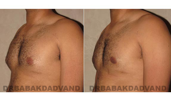Before and After Photos -Gynecomastia - 28 year old man, -left side, oblique view