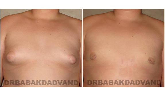 Breast-Gynecomastia: Before and After Photos. 16 year old man, front view