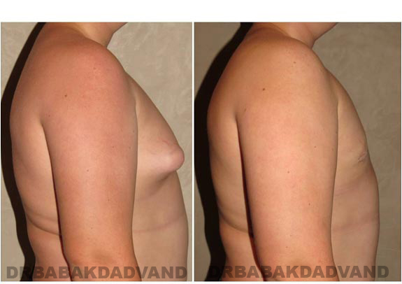 Breast-Gynecomastia: Before and After Photos. 16 year old man, right side view