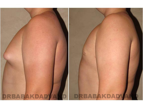 Breast-Gynecomastia: Before and After Photos. 16 year old man, left side view