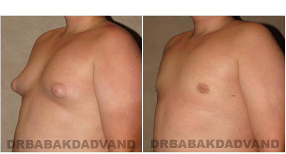 Breast-Gynecomastia: Before and After Photos. 16 year old man, left side, oblique view